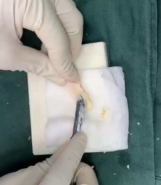 肋软骨雕刻,你不知道的秘密.