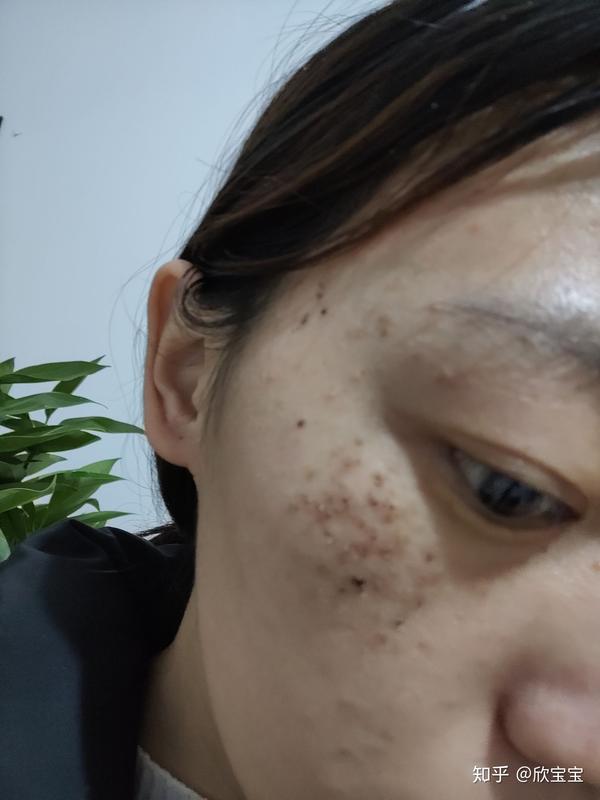 真皮班(褐青痣斑)治疗过程及费用