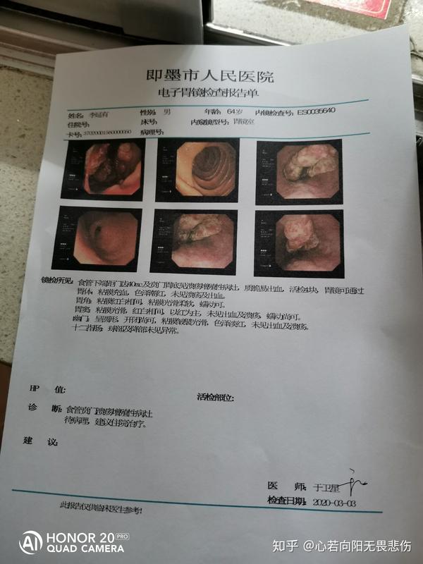 食管贲门溃疡增值性病灶