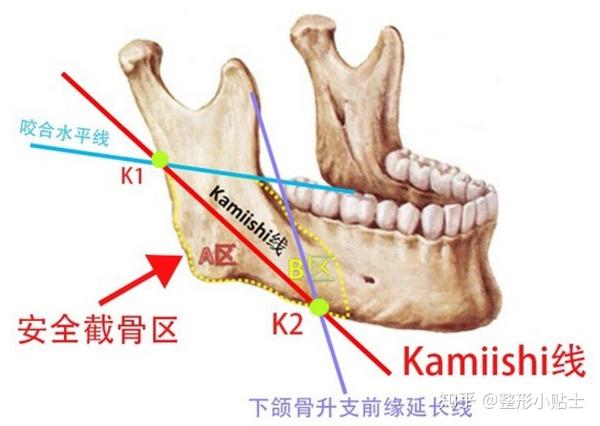 与下颌骨升支前缘延长线与下颌骨前缘的交点k2之间的连线 k1与k2之间