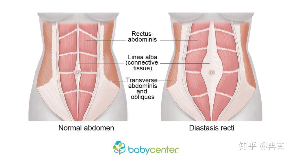 产后腹直肌分离在视觉上最直接的表现就是在你的腹部中线,也就是你的