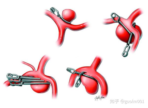 目前动脉瘤修补术主要包括开颅夹闭和血管内介入栓塞,各有利弊.