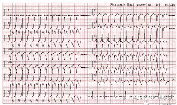 每日读图第1135期室性心动过速