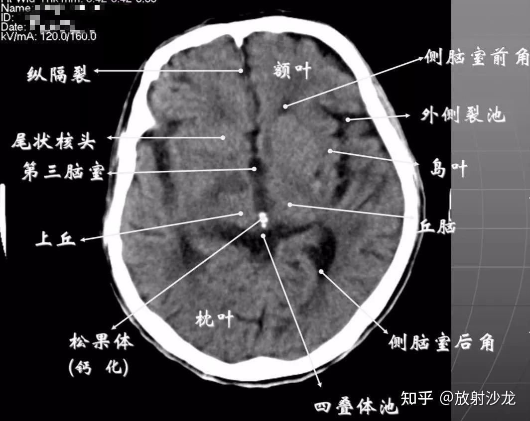 颅脑ct怎么看正常和异常影像分别是什么