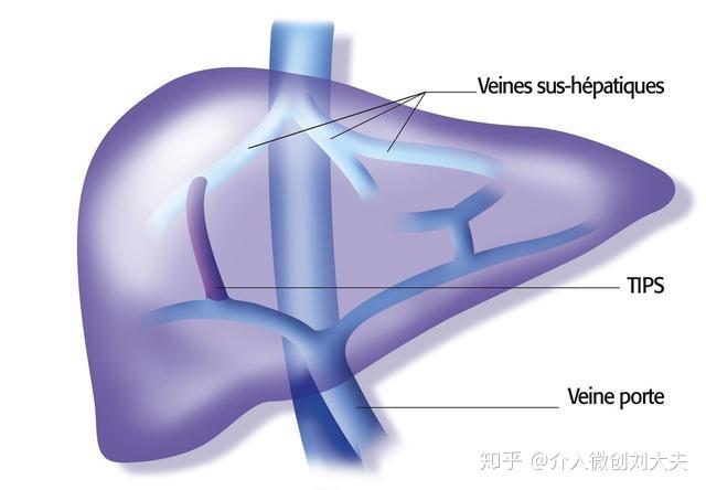 肝硬化tips术后的肝癌患者能否行介入治疗?