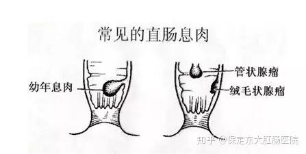 在临床上常见的肛门息肉为炎症性息肉和腺瘤性息肉.