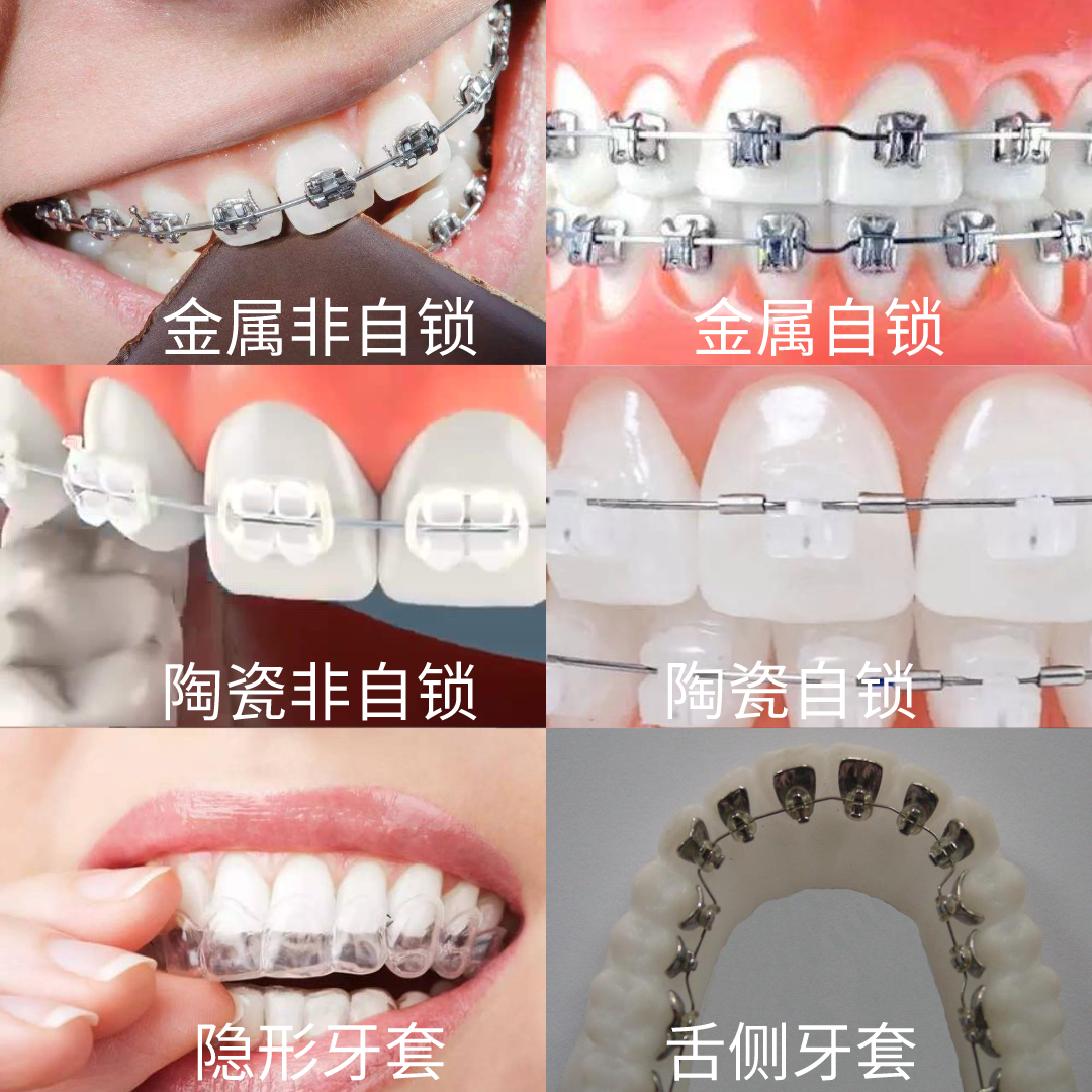首先给大家说一说, 按照材料来分类:牙套有金属牙套,陶瓷牙
