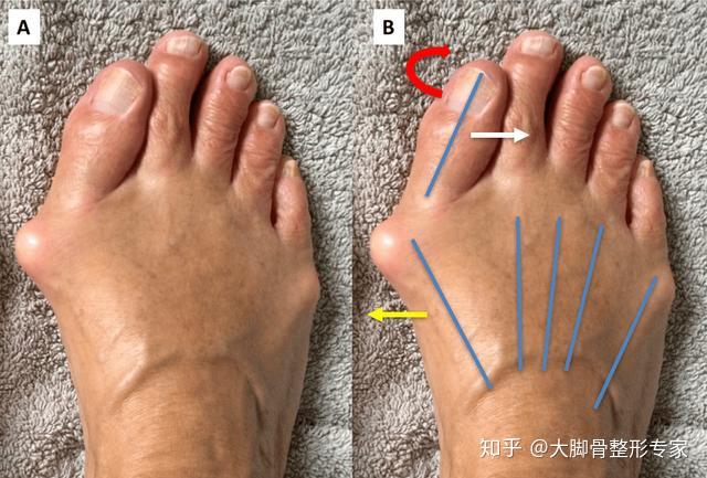 您见过大拇趾关节凸起吗30分钟就能有效矫正大脚骨