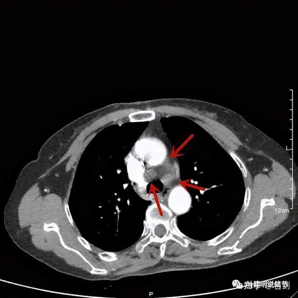 那么当然是要警惕恶性程度较高的肺癌伴淋巴结转移了