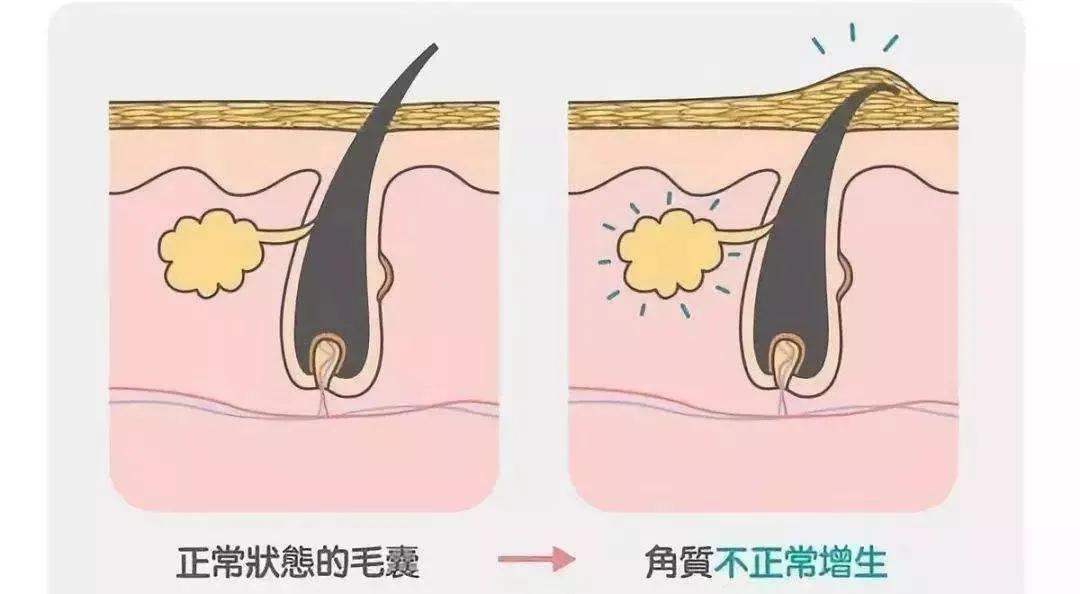 脸上凸凹不平的颗粒是毛周角化吗
