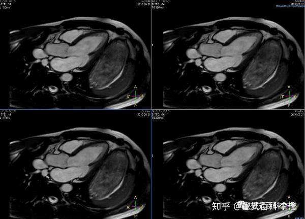 心脏磁共振技术大全三
