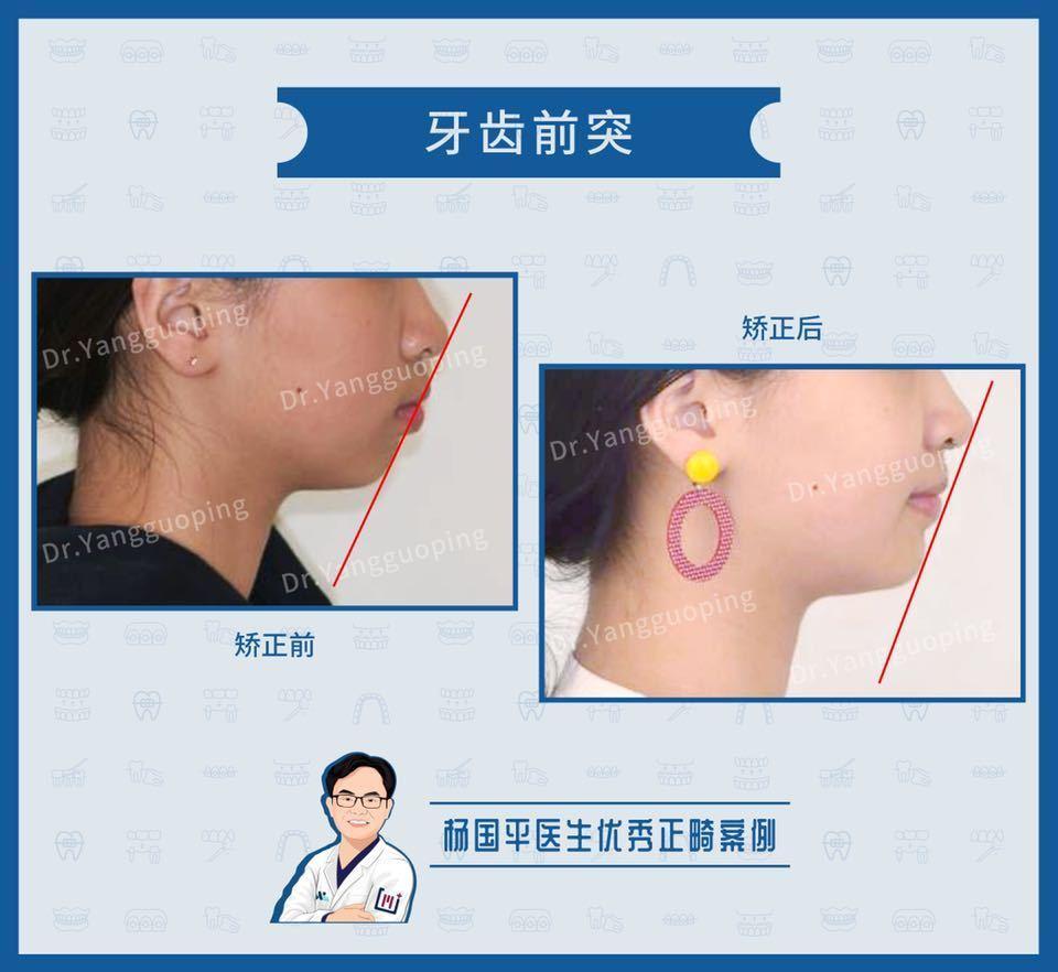上海舌侧矫正:上颌前突 高角面型案例分享