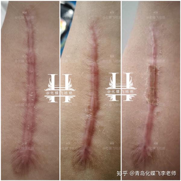 孔孟之乡济宁,骨折手术疤痕,装钢板取钢板两次手术,刀口深疤痕硬.