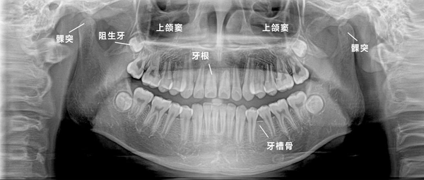 全颌曲面断层片及相关标志点