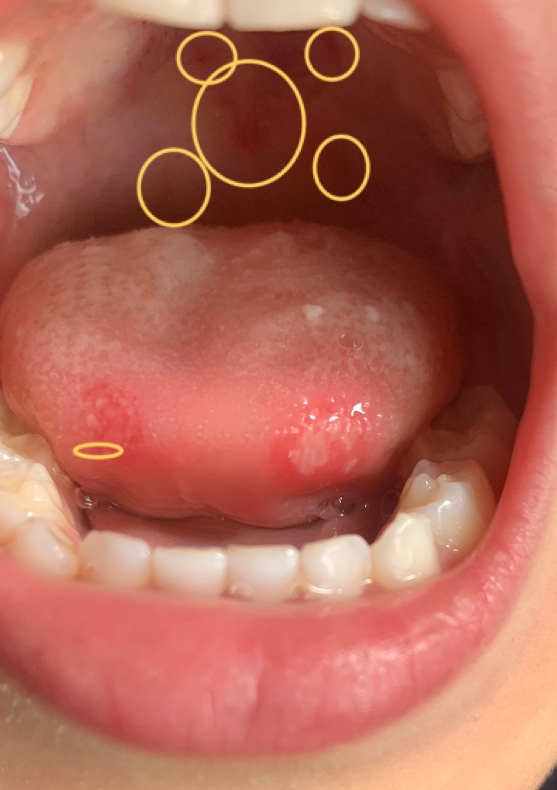 手足口症状:1.上颚很多红点,舌头也有手足口为临床确诊疾病.