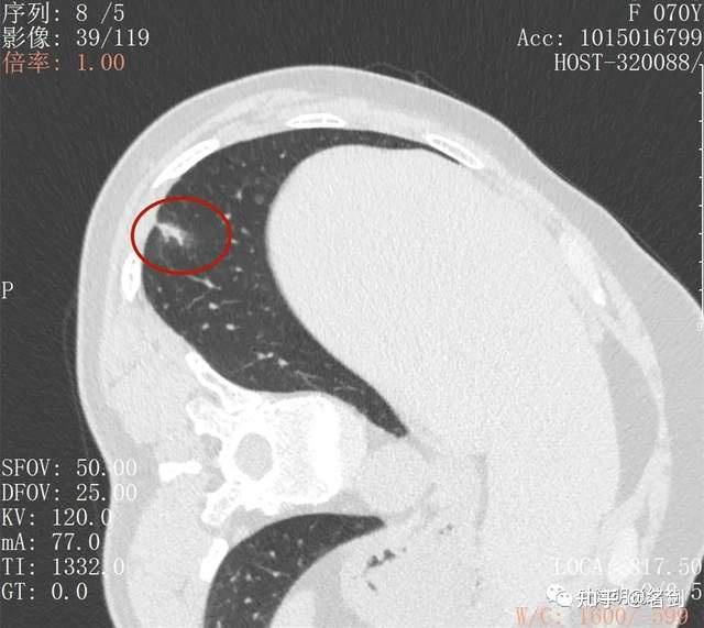 此层面见病灶部分边缘向内凹陷(黄色,当然也可理解为缺乏膨胀性,主要
