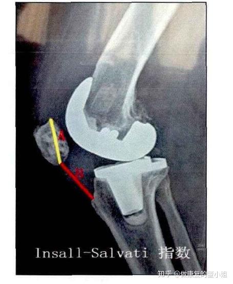 膝关节康复常见误区019——膝关节伸不直如何处理