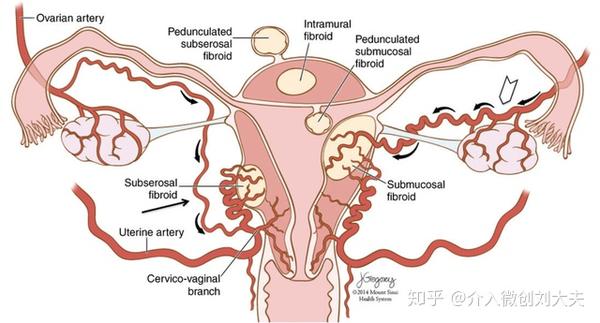 子宫肌瘤位置示意图