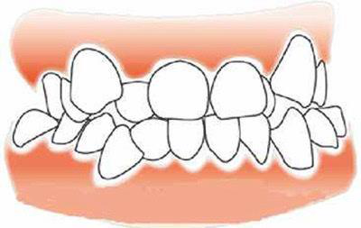 造成牙齿不齐的因素有哪些?