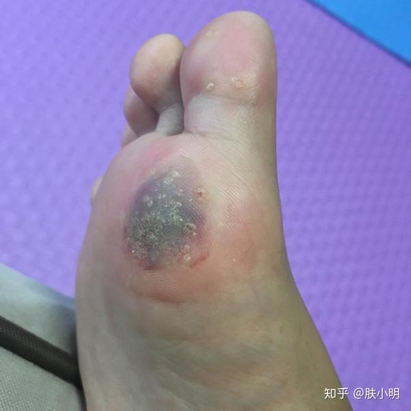 跖疣冷冻知识的全面讲解