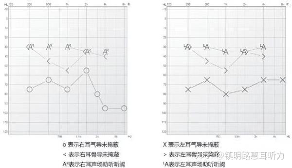 3.3 声导抗测试
