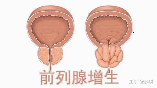 前列腺炎,前列腺增生该如何辨别?