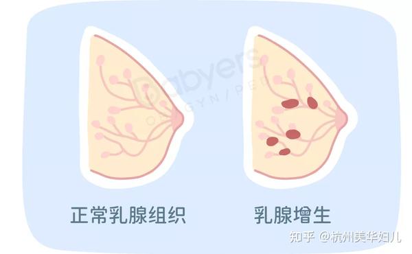 最常见的乳腺问题 ●●● 01 乳腺小叶增生