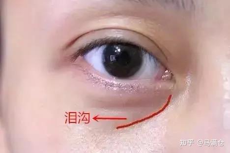 眼袋重泪沟轻只做眼袋要当心这个问题