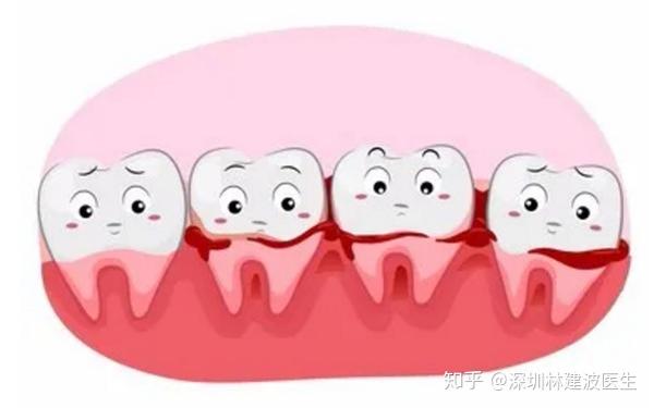 每4个人中有3个人牙龈出血竟然是口腔卫生不好导致的选择护牙工具很
