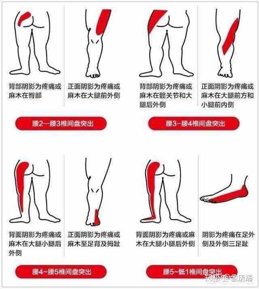 不同部位椎间盘突出症状分布