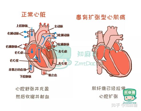 扩张型心肌病的心脏相比于正常人的心脏