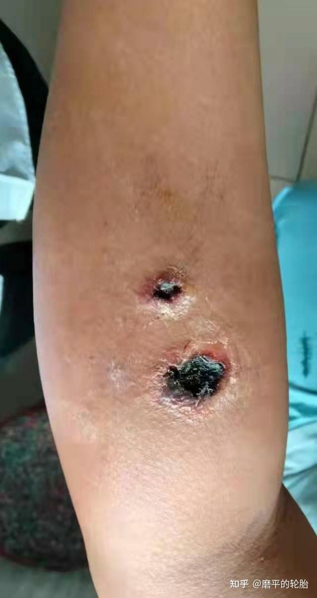 文水县发生9例疑似皮肤炭疽疫情病例已隔离治疗炭疽的传染条件是什么