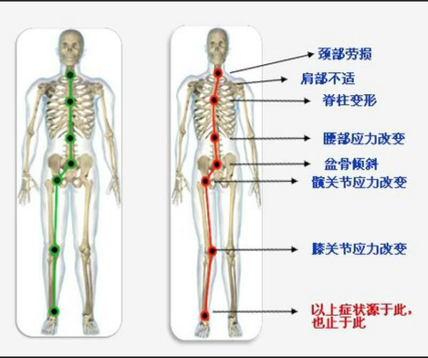 扁平足并且xo腿,可以故意走路用脚掌内侧触地,发力,来