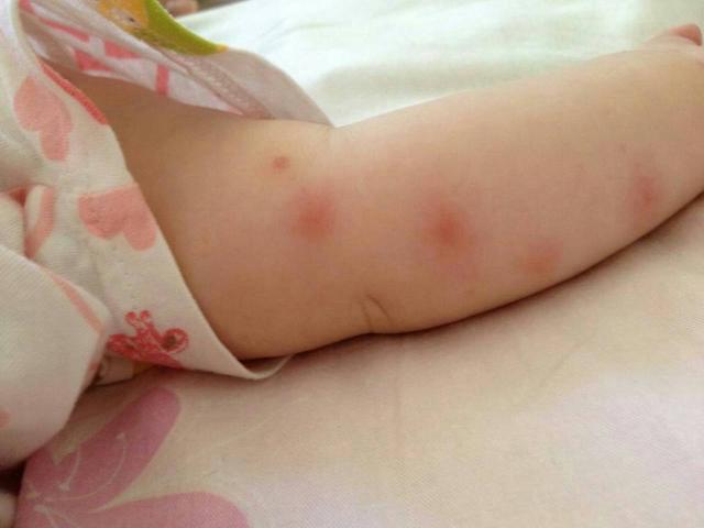 宝宝被蚊虫叮咬了如何护理和预防