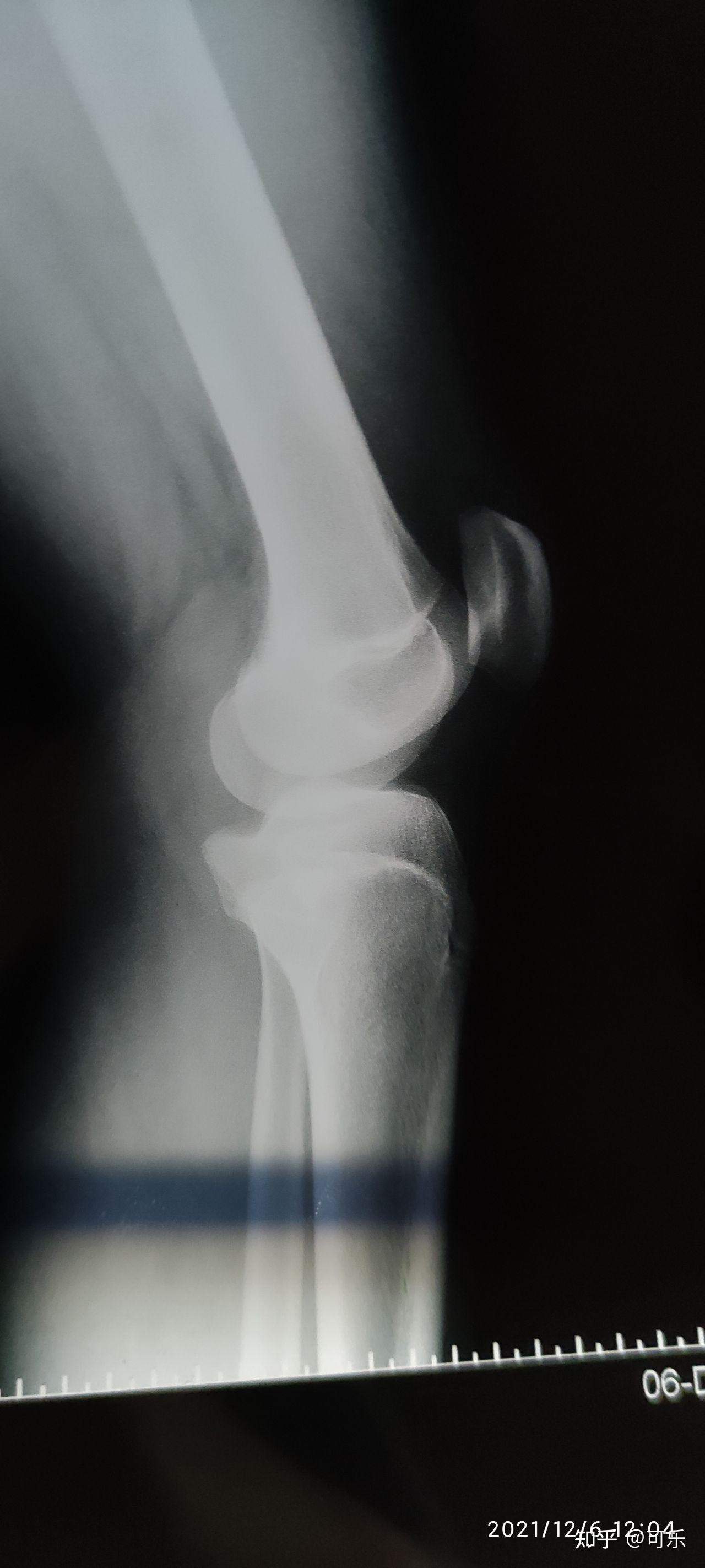 家人们帮我看看我这骨骺线属于一个什么闭合程度