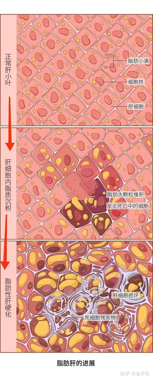 凭实力将脂肪肝吃回去