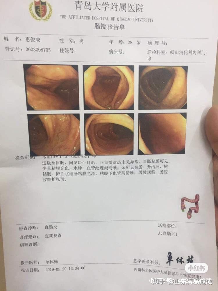 溃疡性结肠炎