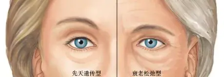 眼袋可以分为两种类型:先天遗传型和衰老松弛型.