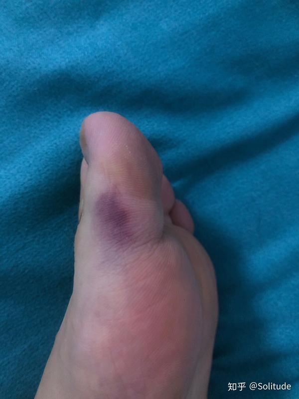 脚的大拇指第二节外侧发紫不痛是怎么回事啊