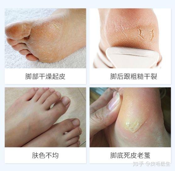 皮肤的癣菌滋生会引起脚底脱皮,加重了脚上死皮的产生量