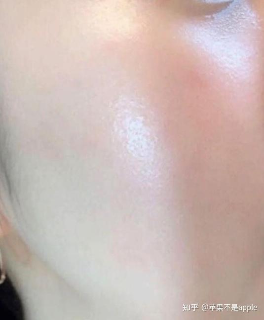 过敏了怎么办皮肤过敏了如何缓解