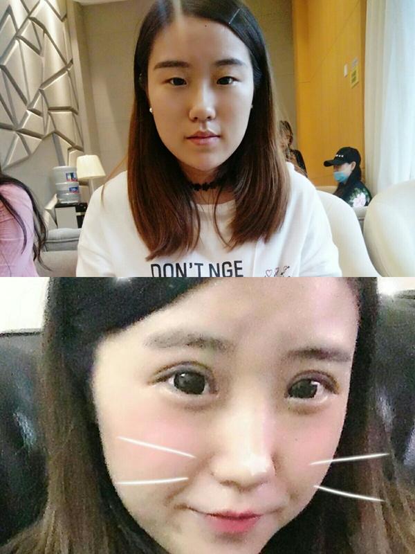 做个眼部抽脂吧,会比较好,我以前也是纯单眼皮,每次化妆好痛苦哦,直接