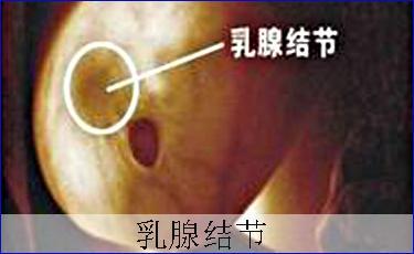 乳腺结节的症状表现主要是乳房胀痛和乳房肿块.