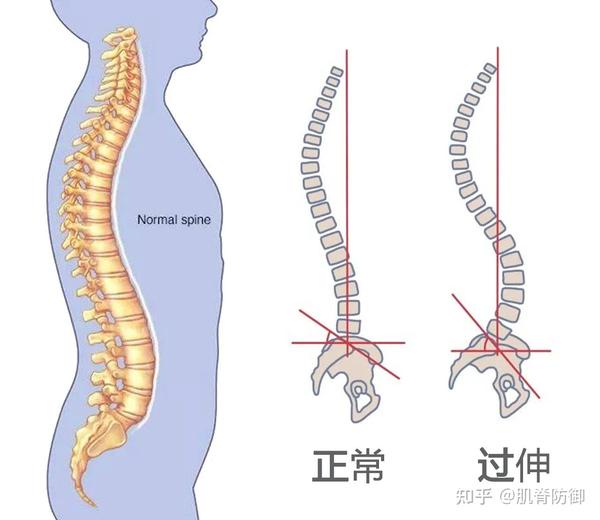 我们知道,正常的腰椎都有一个c型的生理曲线.