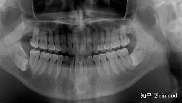 低位埋伏阻生智齿  牙源性囊肿处理