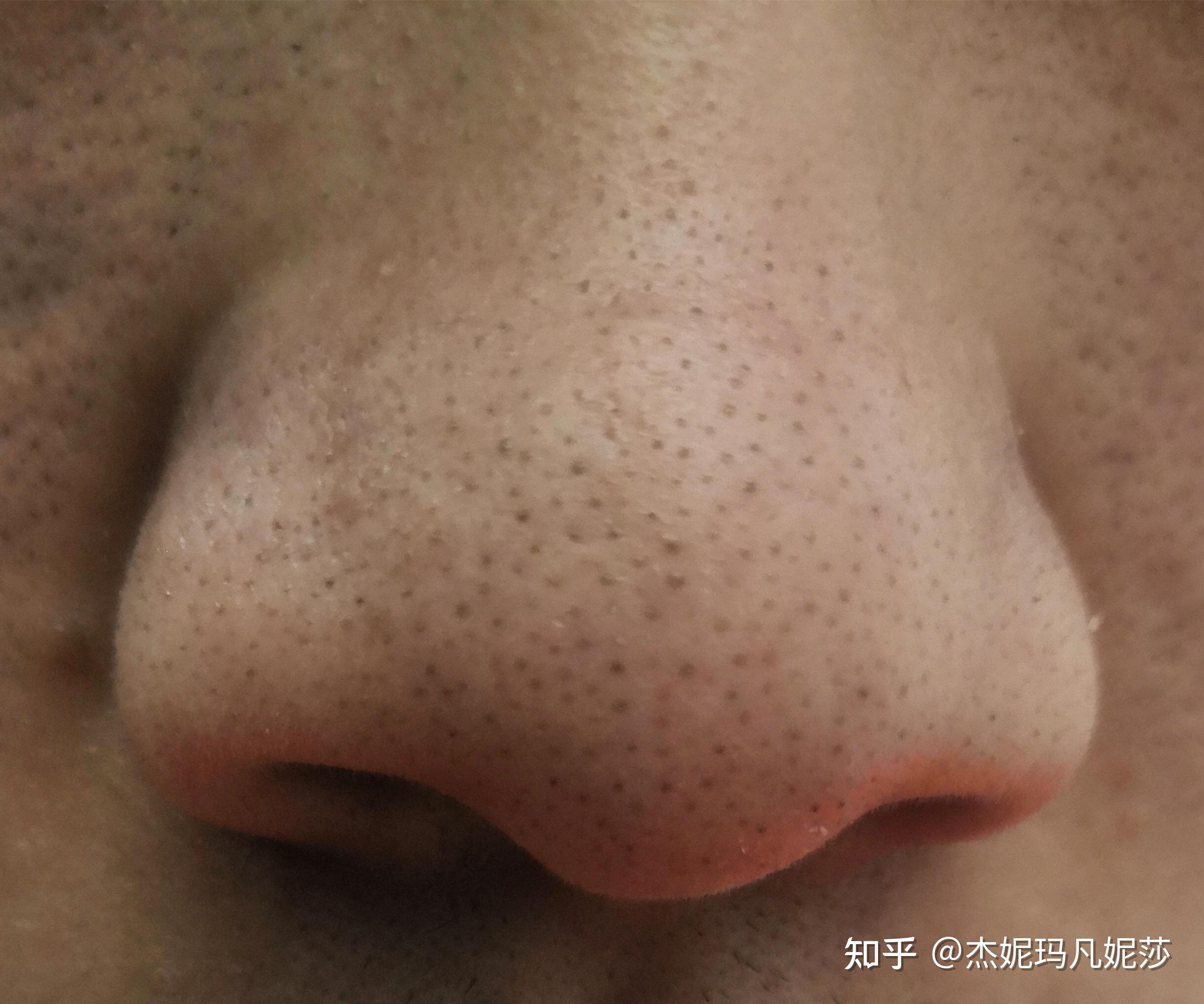 黑头挤出来是白色长条状是不是螨虫引起的