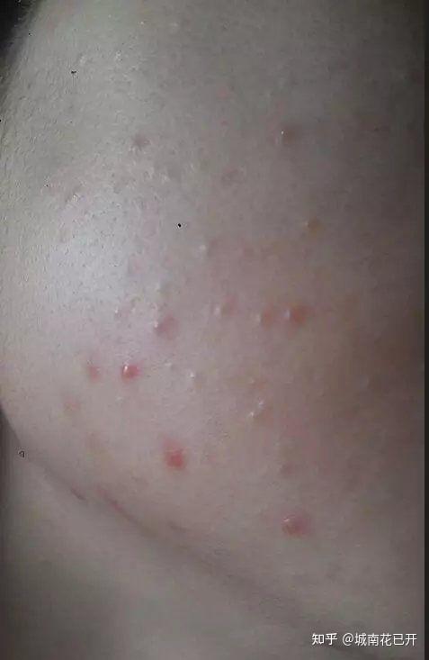 最近很多人问我:老师我最近长了好多粉刺,老师我脸上长了好多白色小