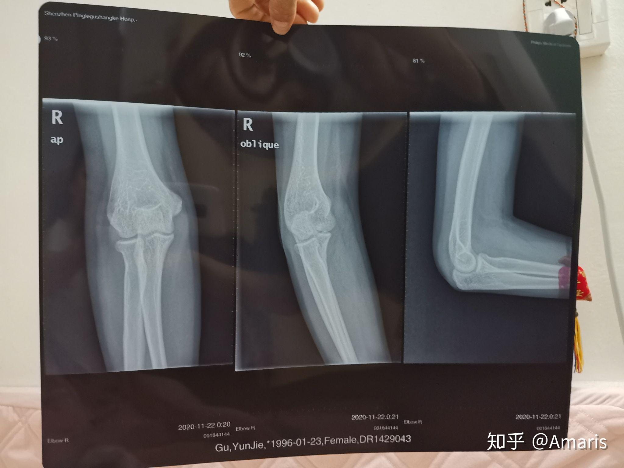 手肘摔伤不能伸直和抬高拍了片子说是可能骨折了但是不确定有会看光片