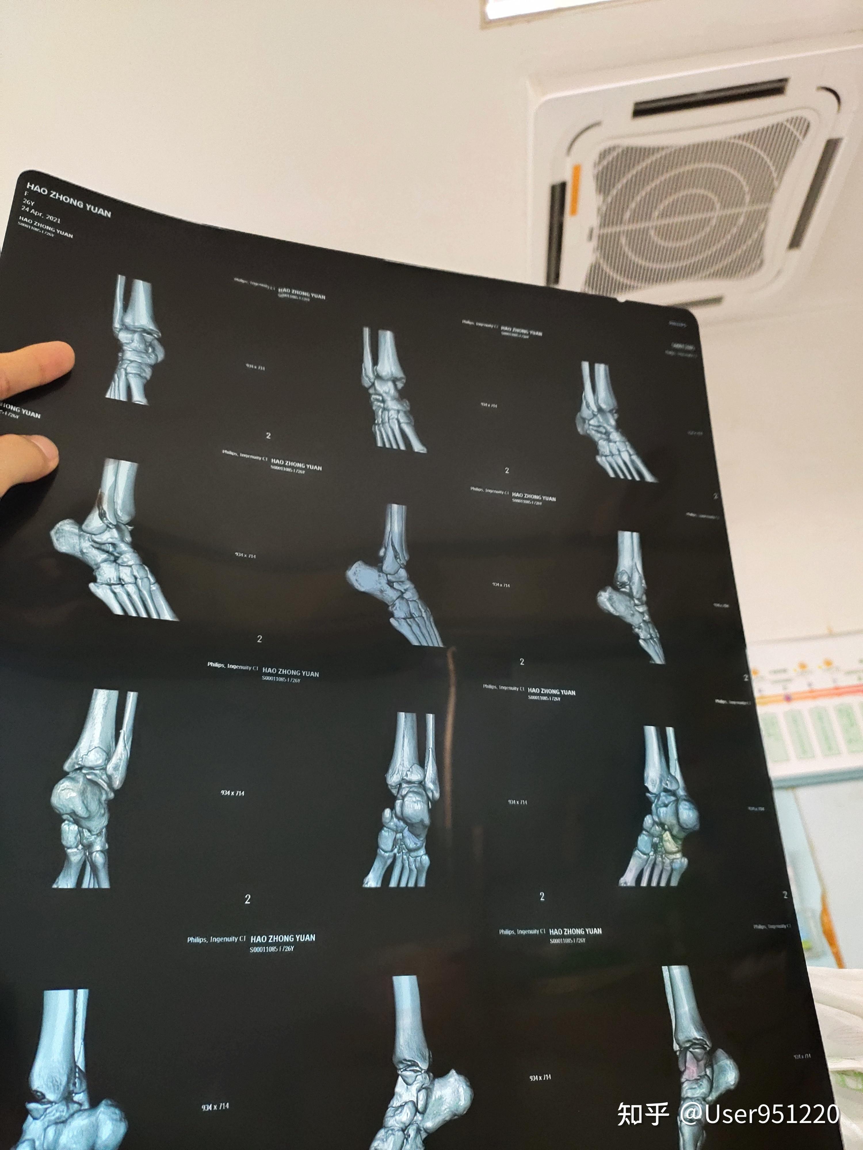 到了医院后,先拍了片子,确定了是脚踝骨折,片子里可以看到三处骨折