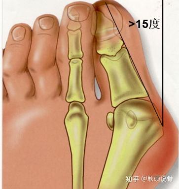 脚趾出现拇外翻应该怎么办